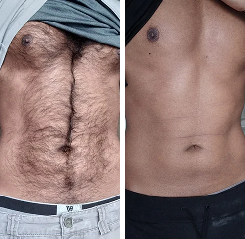 Antes y después en el abdomen