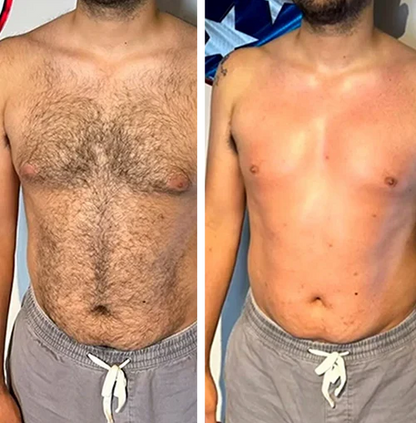 Antes y después en pecho y abdomen