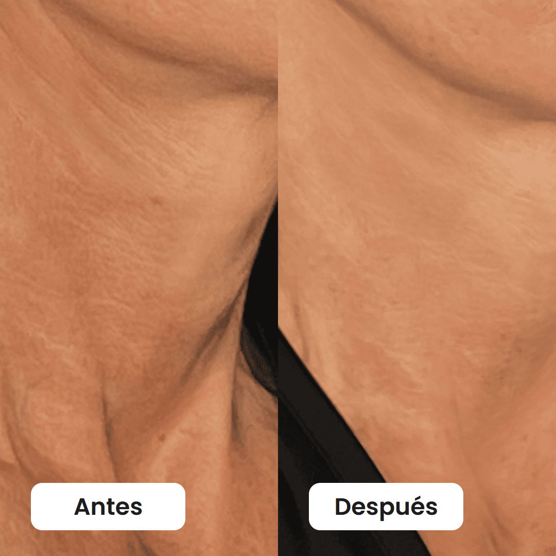 Antes y después del cuello