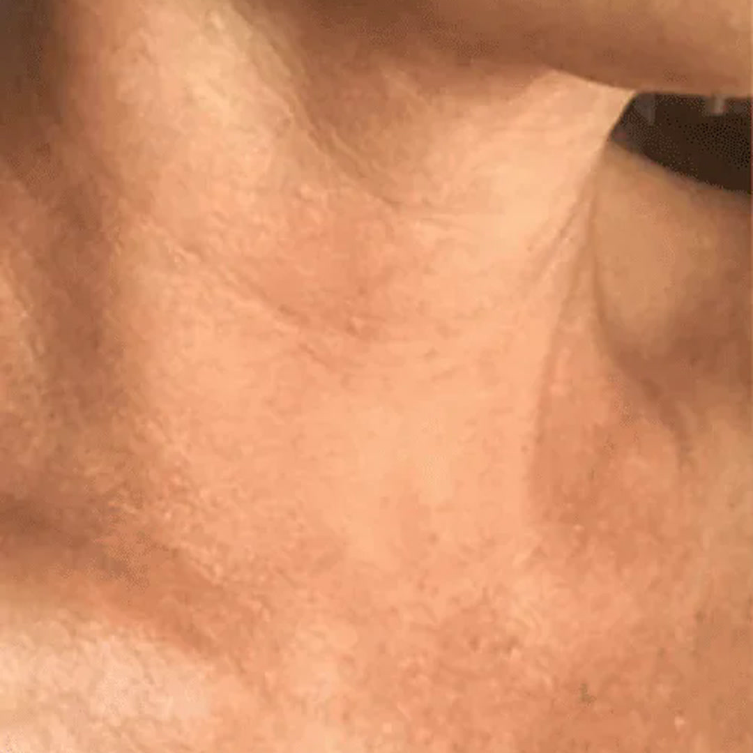 Líneas marcadas en el cuello