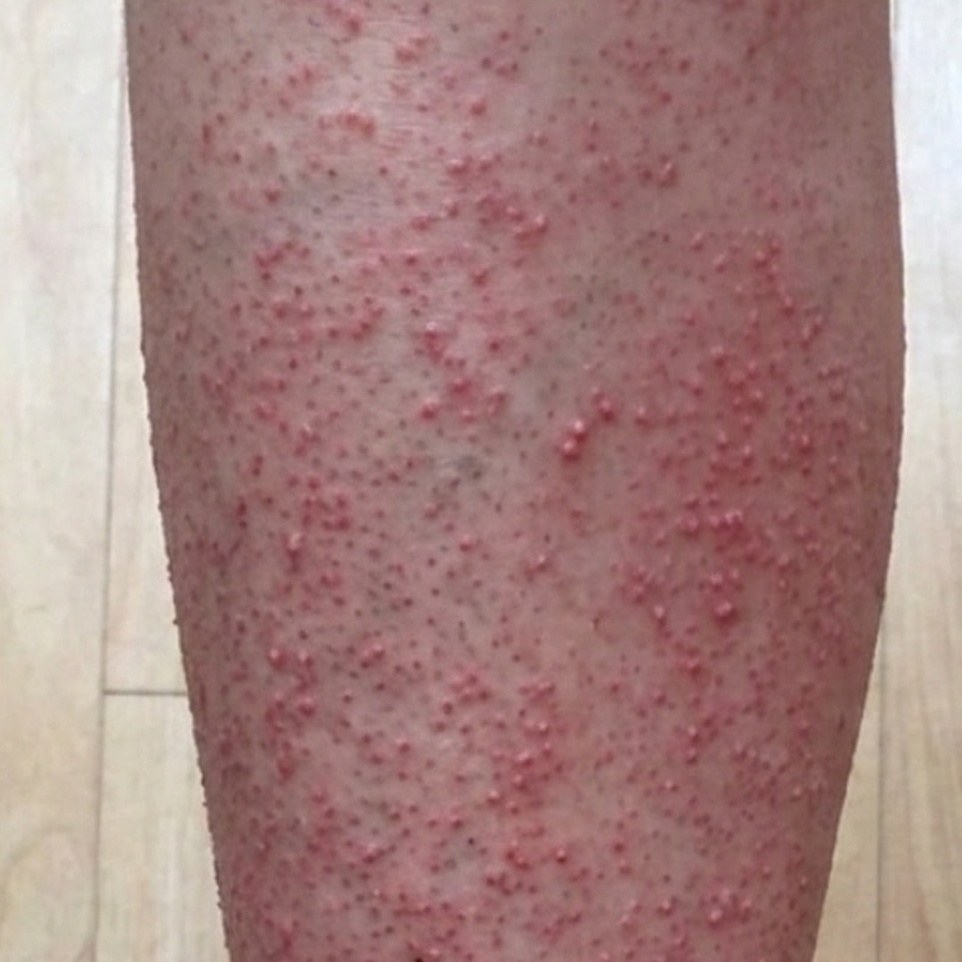 Piel de la pierna con bolitas rojas y aspera